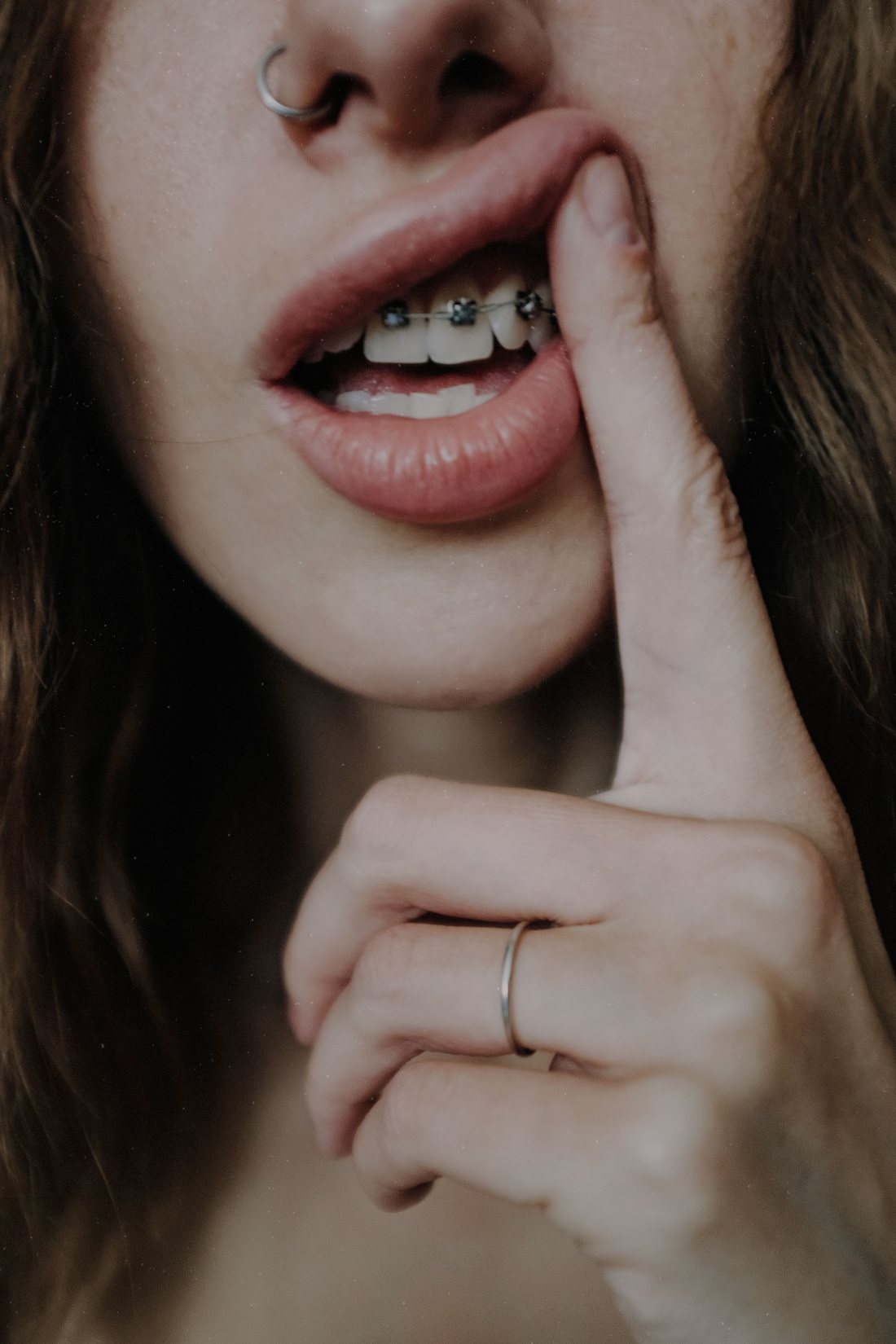 Persona mostrando sus brackets con el dedo.