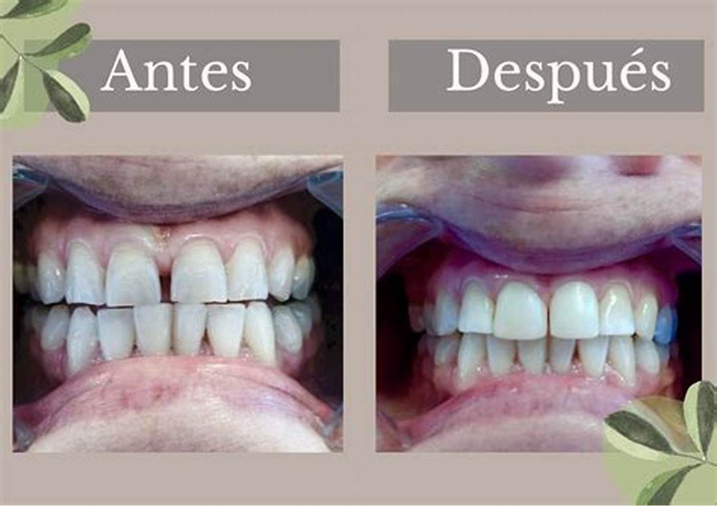 Comparación antes y después de un tratamiento dental publicada por la clínica.